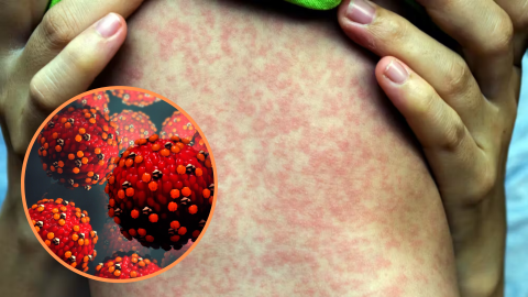 OPS emite nueva alerta epidemiológica por sarampión; México supera los 8 mil casos