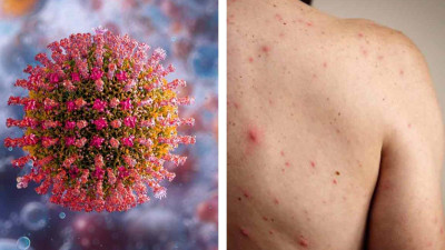 Brote de sarampión en México suma 31 muertos