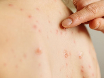 Tamaulipas aún sin casos de sarampión