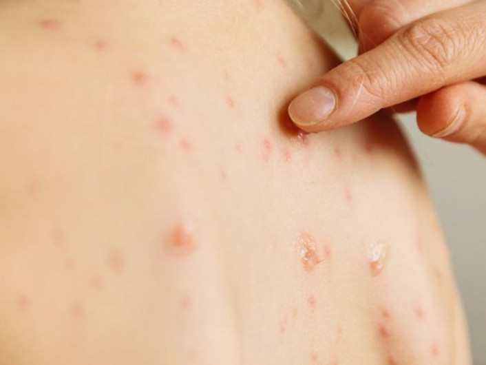 Tamaulipas aún sin casos de sarampión