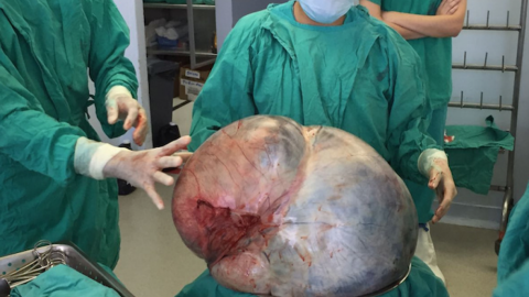 Médicos extraen el tumor más grande del mundo