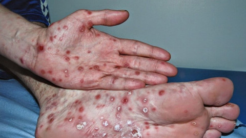 Preocupa aumento de contagios de Sífilis en Nuevo Laredo