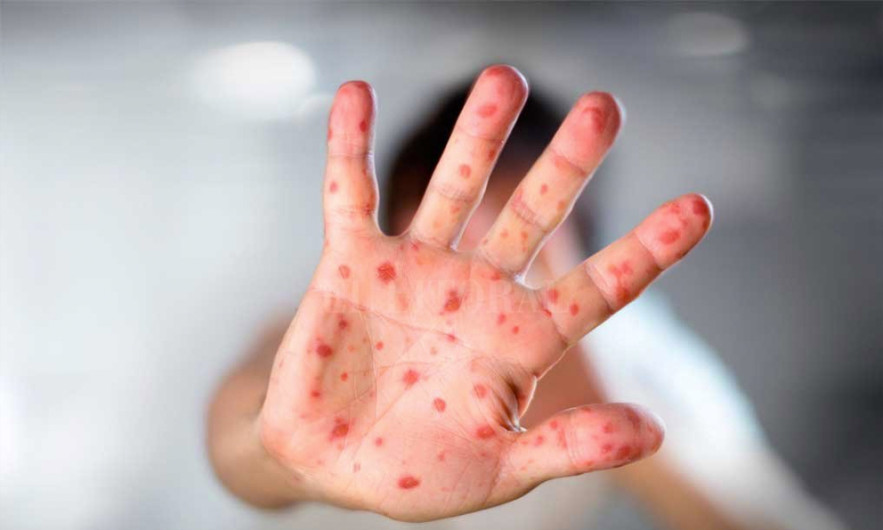 Confirma Secretaría de Salud a mujer con sarampión por contagio importado