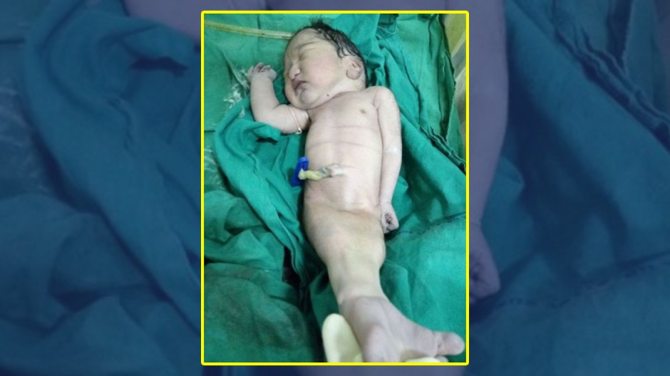 Nace bebé con sirenomelia en India