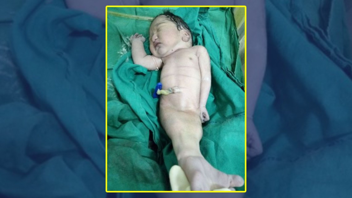 Nace bebé con sirenomelia en India