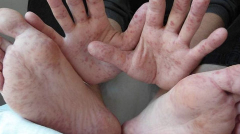 Confirman brote de virus Coxsackie en guardería de Querétaro