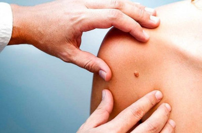 Cáncer de piel causante de una muerte cada 52 minutos