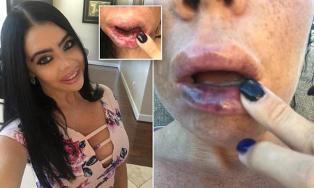 Mujer queda irreconocible tras mal procedimiento de relleno