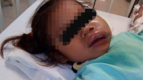 Maestras de kínder entregan a niña con moretones y el labio inflamado