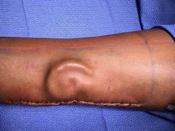 Mujer pierde su oreja y le "crecen" una nueva en brazo