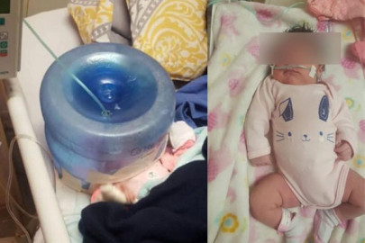 Hospital en Sonora usa garrafón como casco de oxígeno para bebé